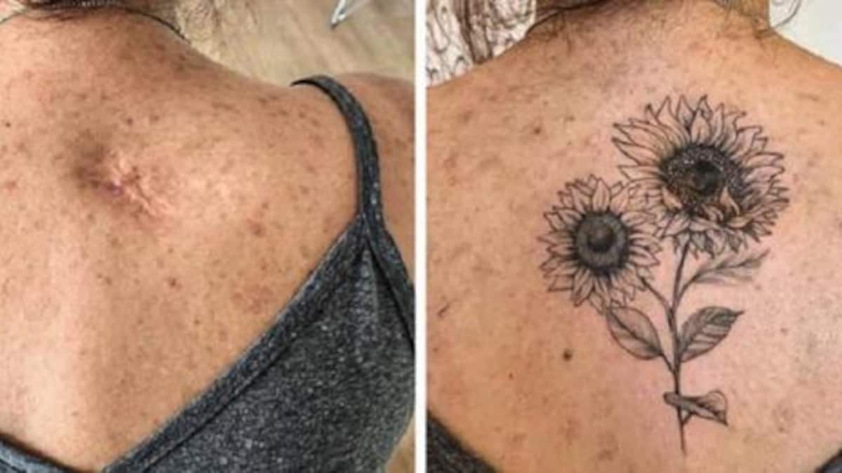 I tatuaggi possono trasformare le tue cicatrici in opere d’arte
