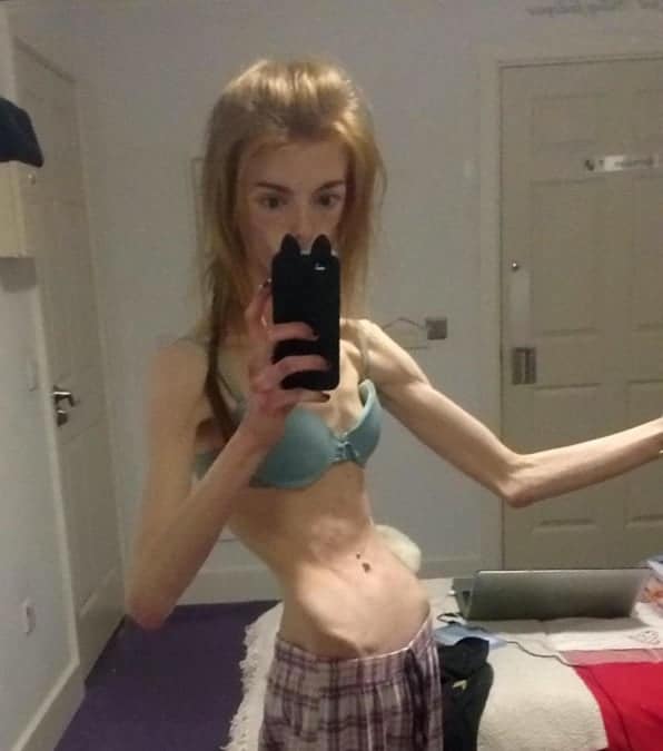 La straordinaria trasformazione di Annie Windley, che soffriva di anoressia e ha perso 29 chili