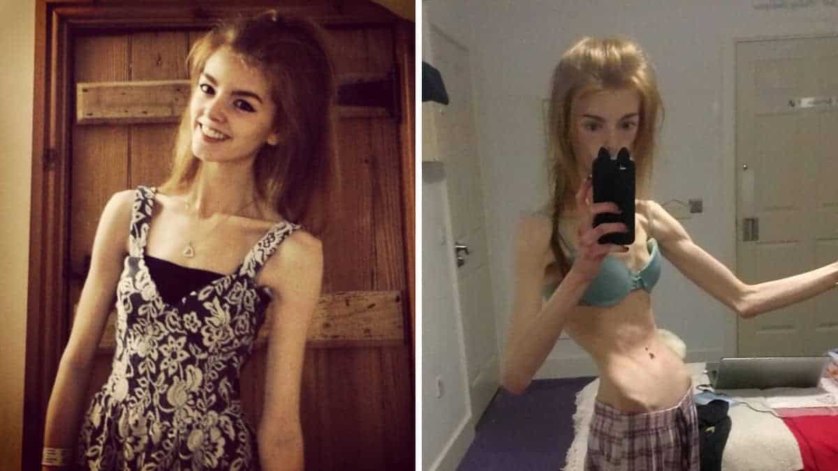 Dopo una battaglia di 5 anni contro l'anoressia, ecco come appare oggi